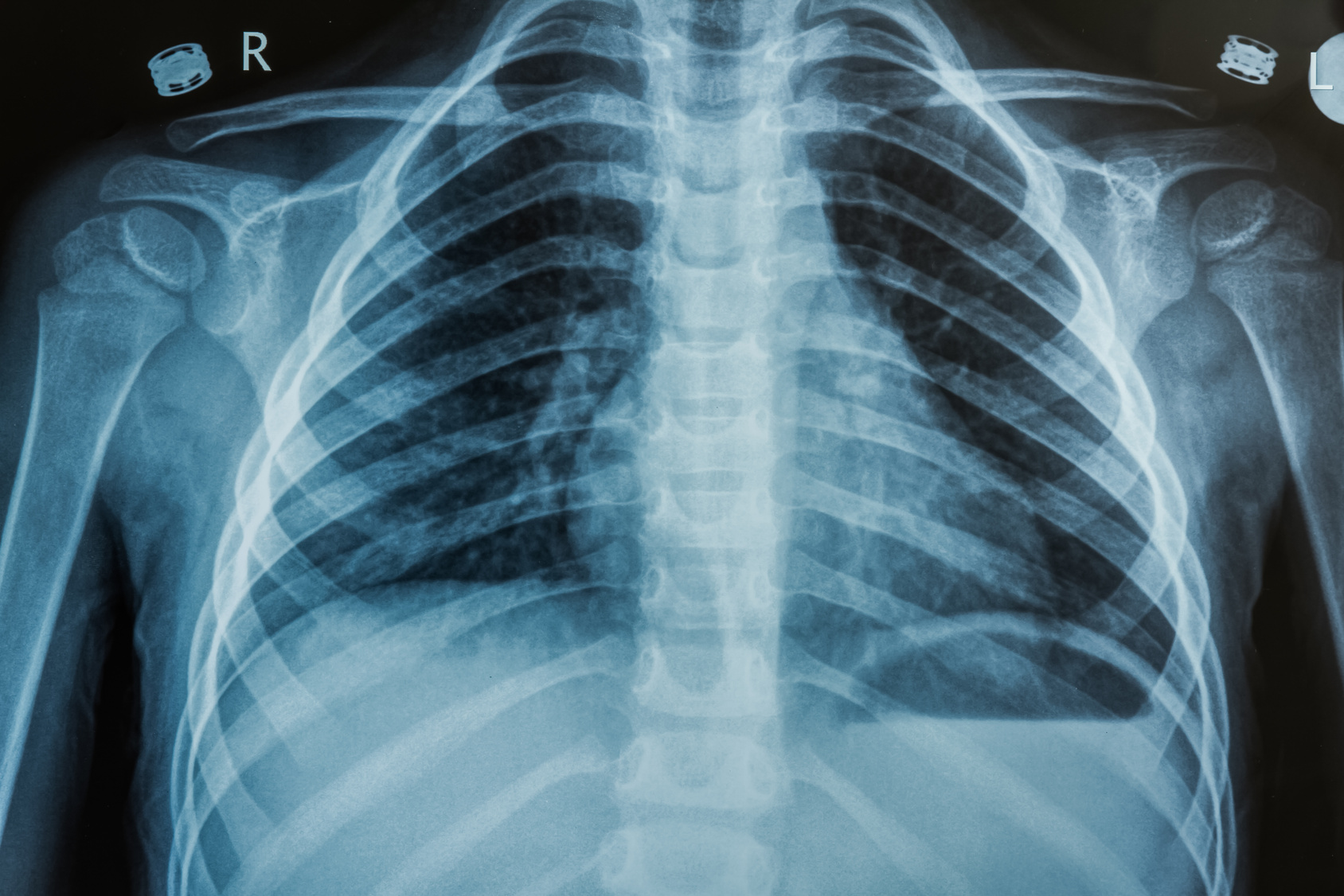 x-ray of ribs