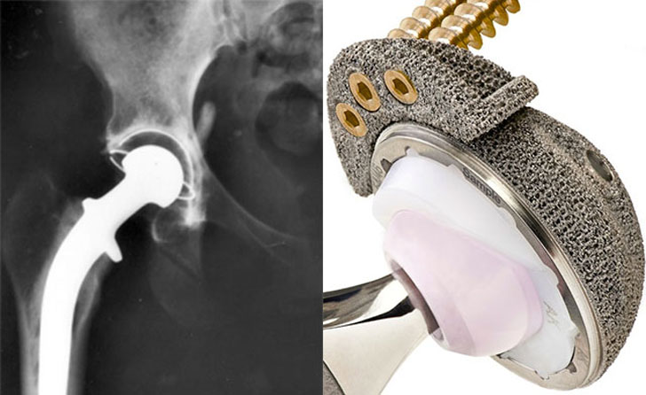 3D-printed-hip-replacement-in-china